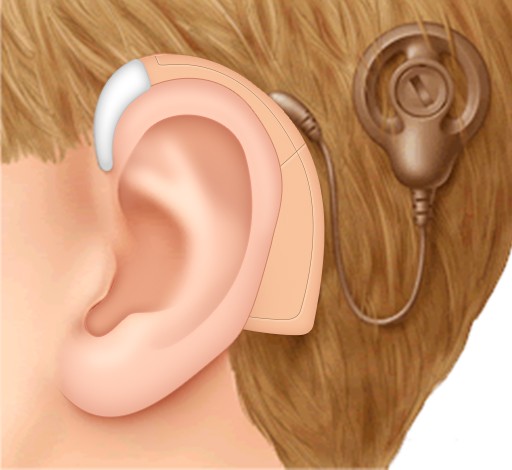 Correct understanding of bone conduction hearing aids